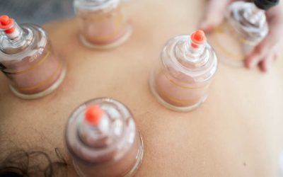 Cupping: Alternative methods for pain management
